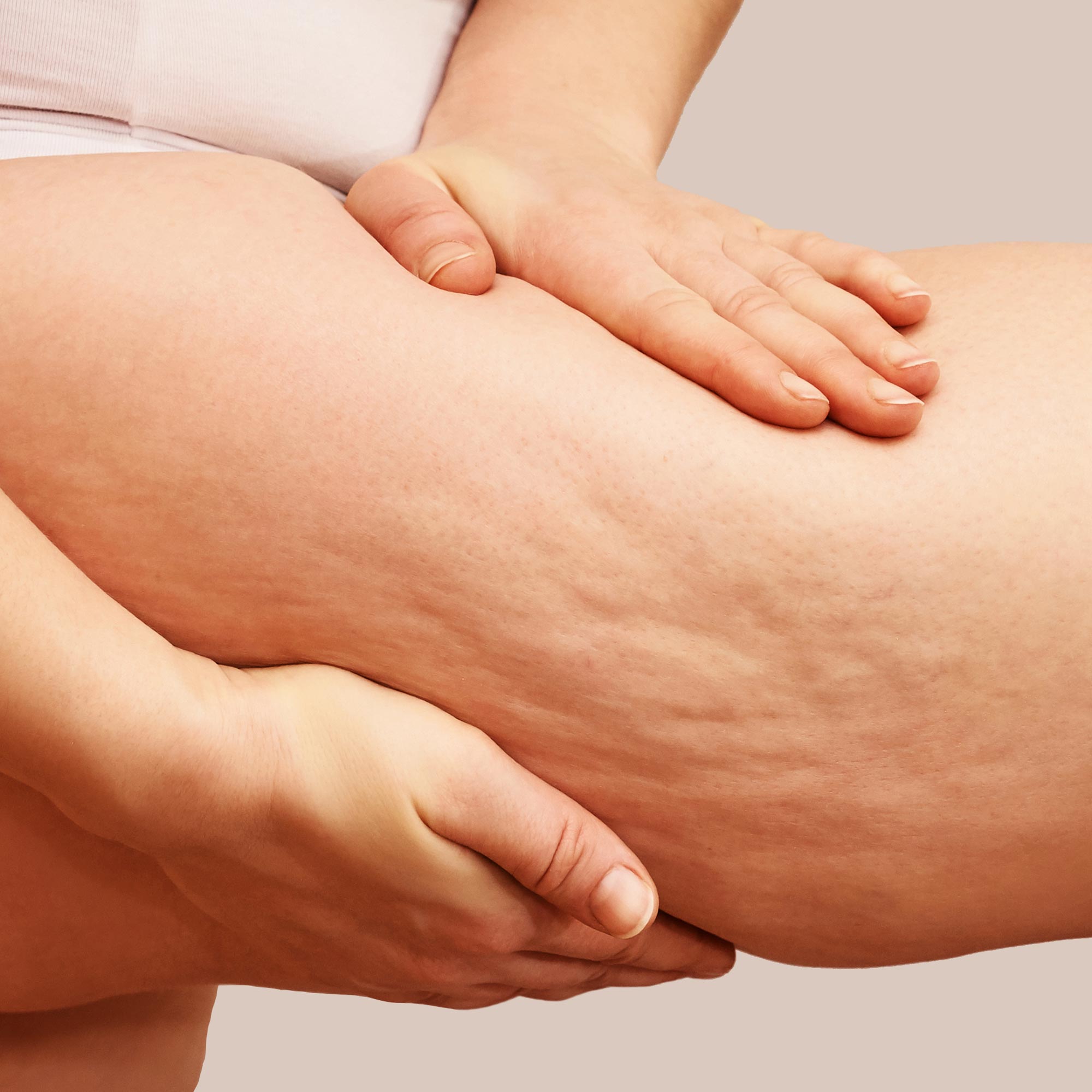 Woman with cellulite